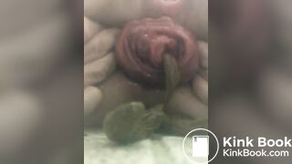 prolapse and shit7