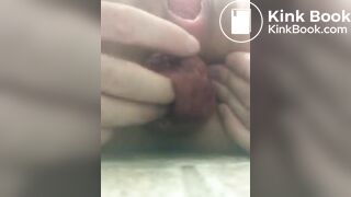 prolapse and shit7