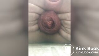 prolapse and shit7