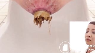 Unusual combination of hard and soft poop