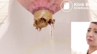 Unusual combination of hard and soft poop