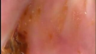 Camera in Arse with poo Asian. Buttcam