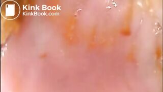 Camera in Arse with poo Asian. Buttcam