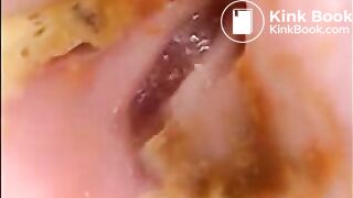 Camera in Arse with poo Asian. Buttcam