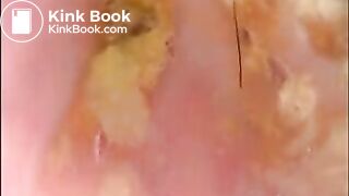 Camera in Arse with poo Asian. Buttcam