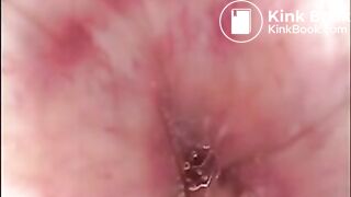 Camera in Arse with poo Asian. Buttcam