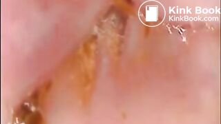 Camera in Arse with poo Asian. Buttcam