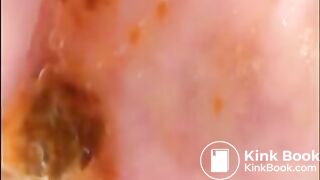 Camera in Arse with poo Asian. Buttcam