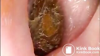 Camera in Arse with poo Asian. Buttcam