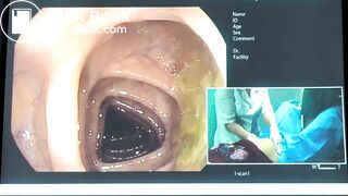 Веселов ВВ Трудная Колоноскопия