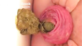 Prolapse and shit, my two favourites