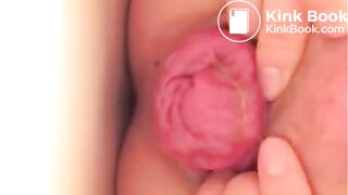 Prolapse and shit, my two favourites