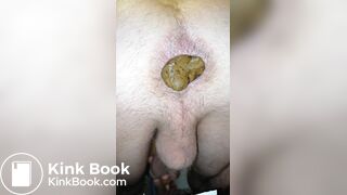 Shit Is So Hard That It Tears Bro's Asshole