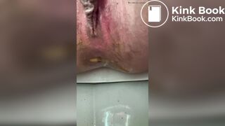 diarrhea 7 times
