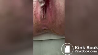 diarrhea 7 times