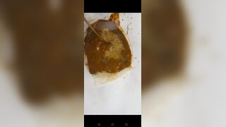 Chinese girl have watery diarrhea1