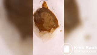 Chinese girl have watery diarrhea1